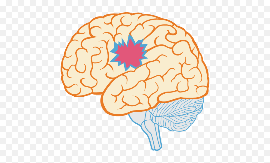 Brain Myth Damage Is Always Permanent - Brainhq From Brain Damage Png,Damage Png