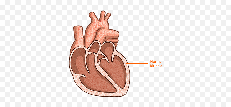 Heart Failure With Reserved Ejection Fraction Hfref U2014 U201ca - Heart Failure With Preserved Ejection Fraction Icon Png,Anatomical Heart Icon