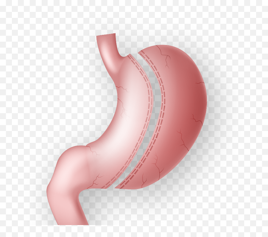 Gastric Sleeve Surgery By Dr Juan Francisco Hidalgo In - Illustration Png,Stomach Png