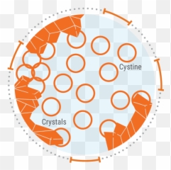 What Is Cystinosis Defining Nephropathic Juvenile And - Language png
