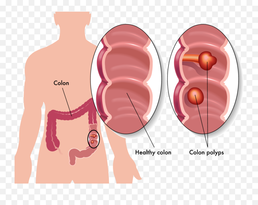 Colon Cancer U2013 What You Need To Know U2014 Hippocrates Media - Intestinal Polyps Png,Cancer Png