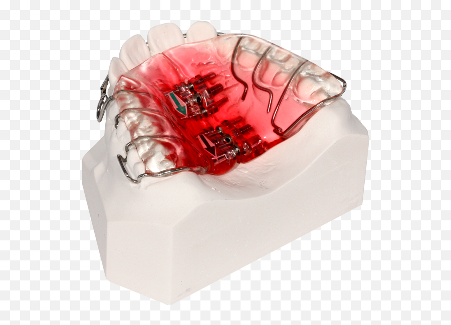 Upper Spit Plate - Dental Braces Png,Spit Png