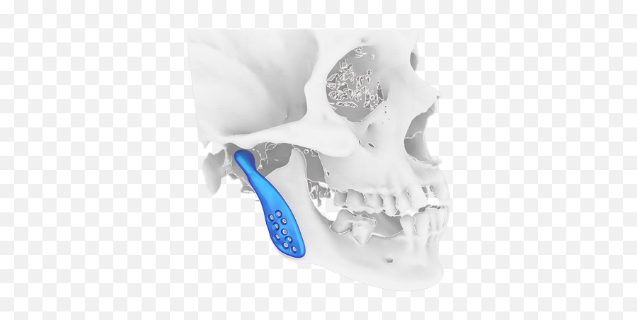 Tmj Prosthesis - Protesis De Condilo Mandibular Png,How To Wear Your Jawbone Icon