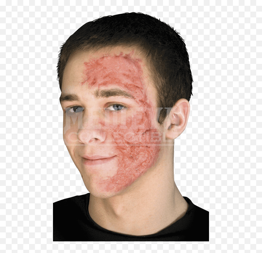 Hd Burn Scar Face Free Unlimited Downl 628958 - Png Burn Scars Png,Burn Png