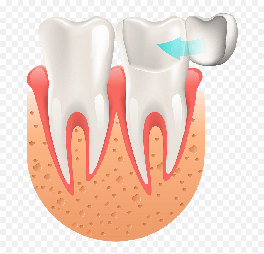 Porcelain Veneers In Montclair Nj - Veneers Teeth Procedure Png,Procelain Icon