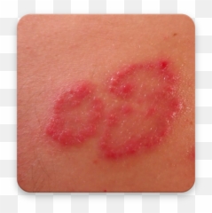 How To Cure Skin Rashes Apk 13 - Download Apk Latest Version Body Fluid Png,Rash Icon