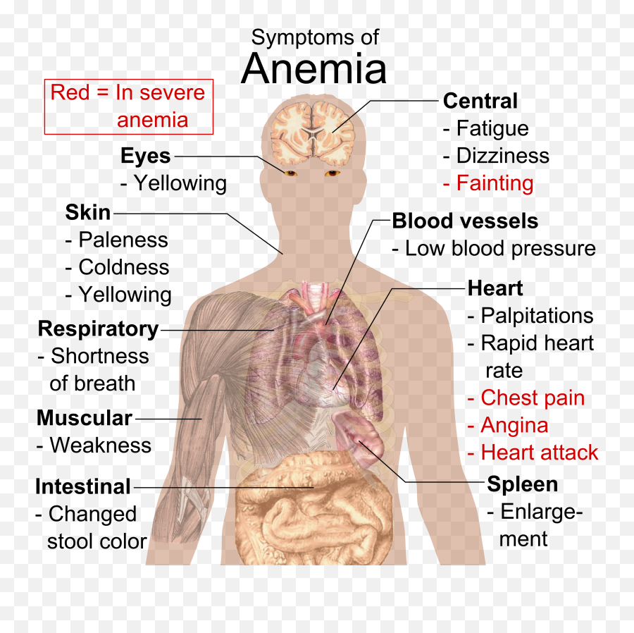 Filesymptoms Of Anemiapng - Wikimedia Commons Symptoms Of Iron Deficiency Anemia,Chest Png