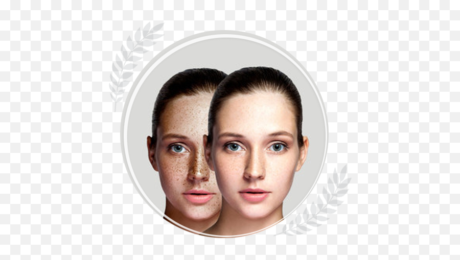 Freckles - Srisa Laser Derma Cosmo Clinic Skin Whitening Fenugreek For Face Png,Freckle Icon