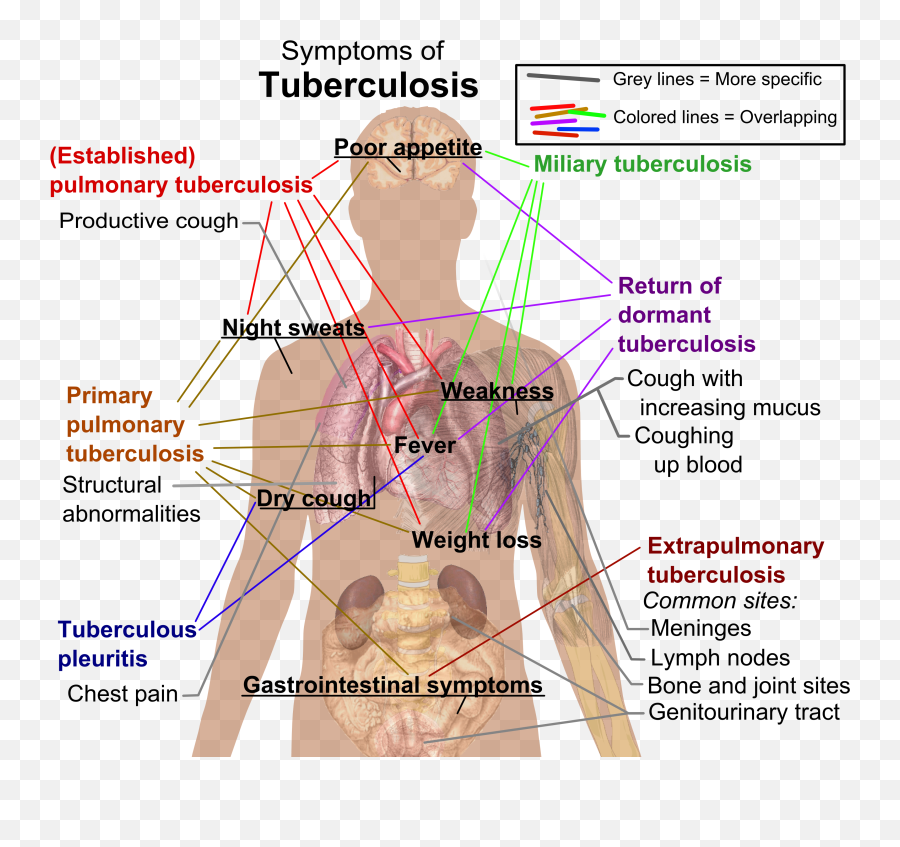 Tuberculosis Symptoms - Tuberculosis Tests Png,Action Lines Png